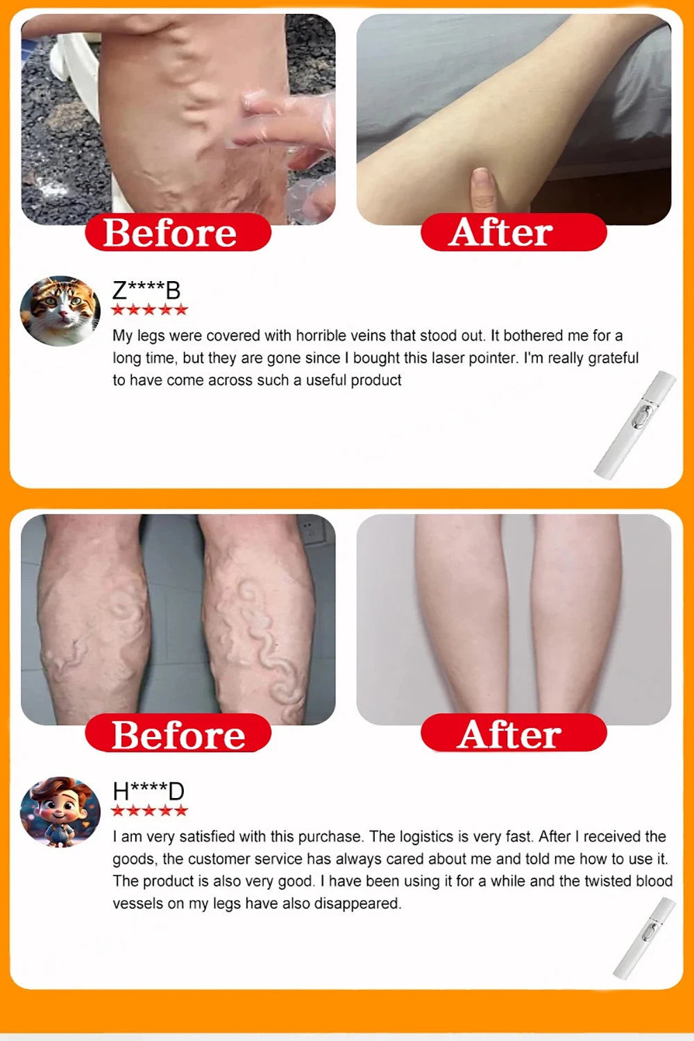 Varicose Vein Lampshade Therapy Effective Improved Blood Circulation Relief Of Dilated Vasculitis Legs Phlebitis Care Product