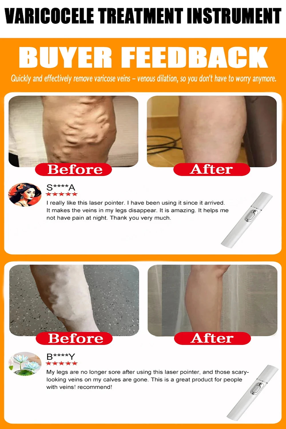 Varicose Vein Lampshade Therapy Effective Improved Blood Circulation Relief Of Dilated Vasculitis Legs Phlebitis Care Product